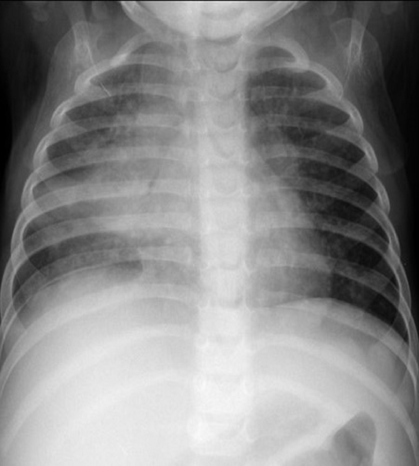 Complicated Lymph Node Disease The Union